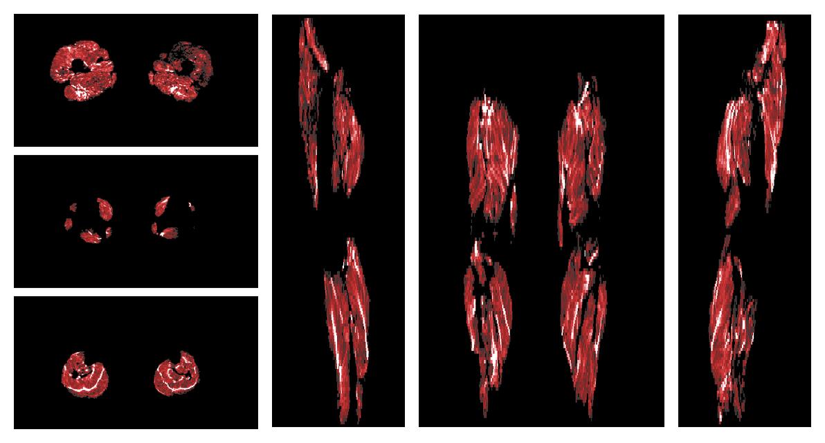 Muscle fiber tract density map based on whole leg DTI based fiber tractography.