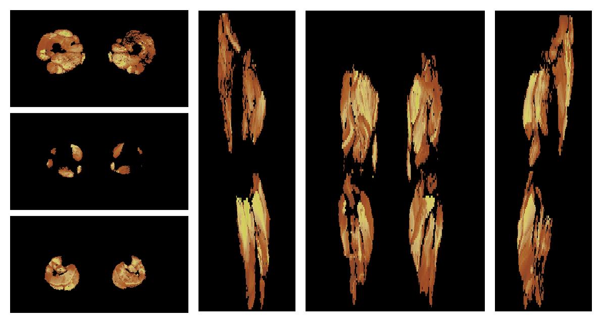 Muscle fiber tract length map based on whole leg DTI based fiber tractography.