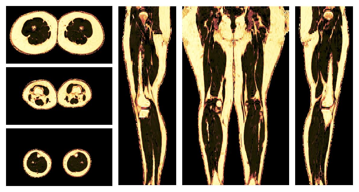 The fat fraction of the lower extremity obtained from the dixon reconstruction for muscle water fat quantification.