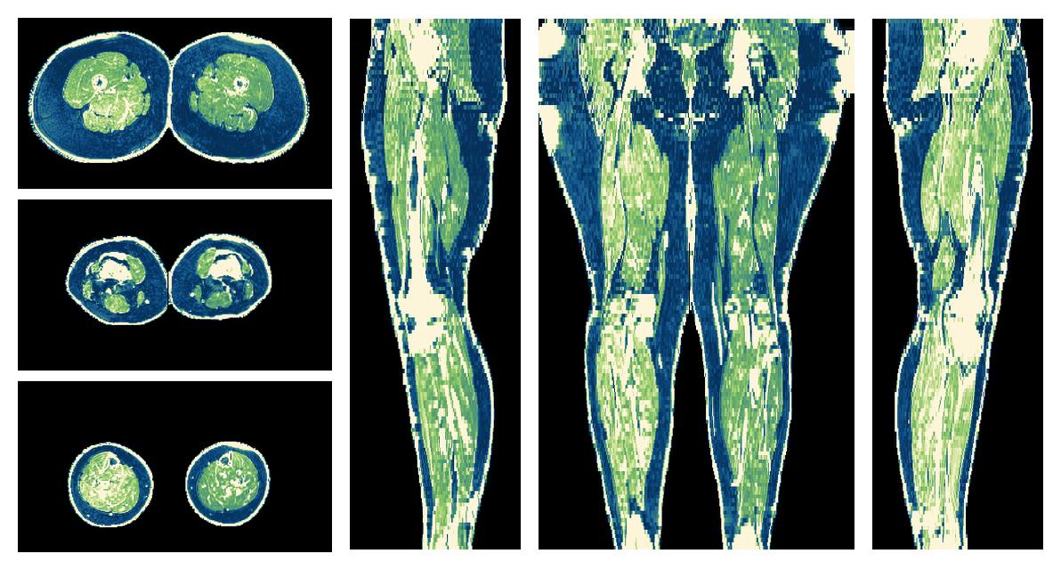 The R2 star relaxation time of the lower extremity obtained from the dixon reconstruction for muscle water fat quantification.