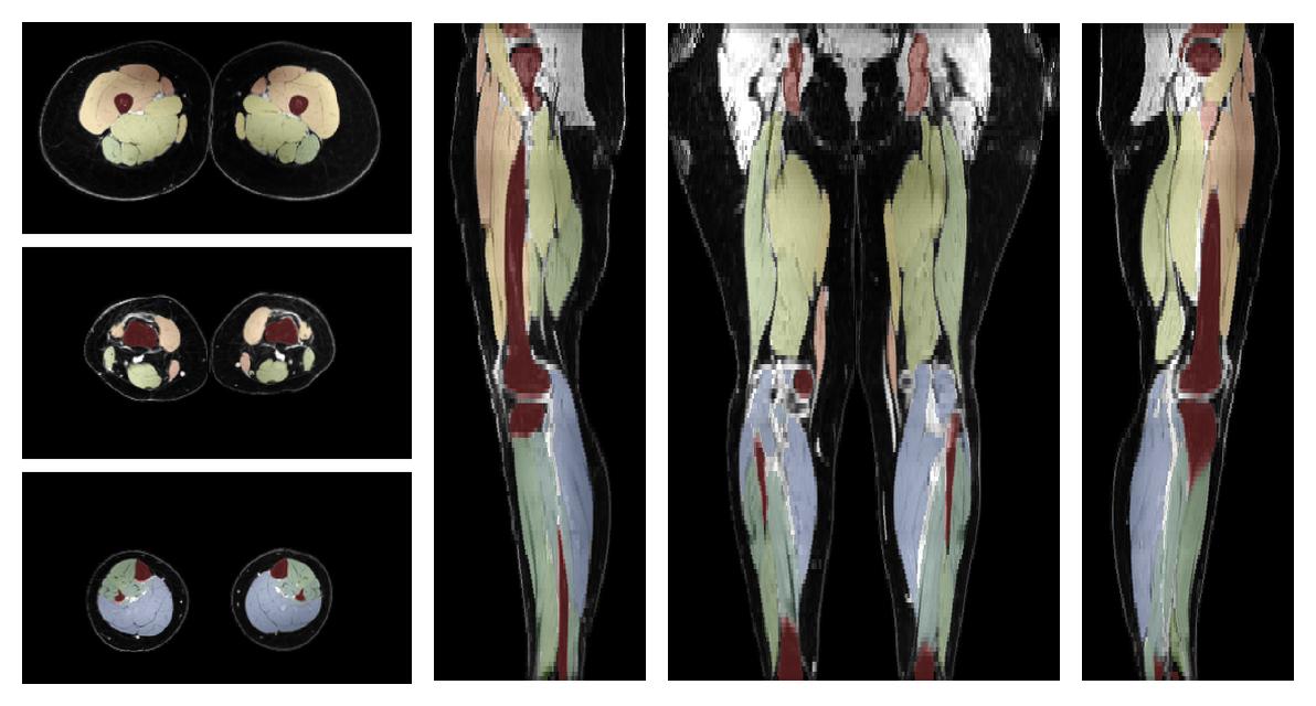 Overlay of automated muscle segmentation labels on dixon water image.