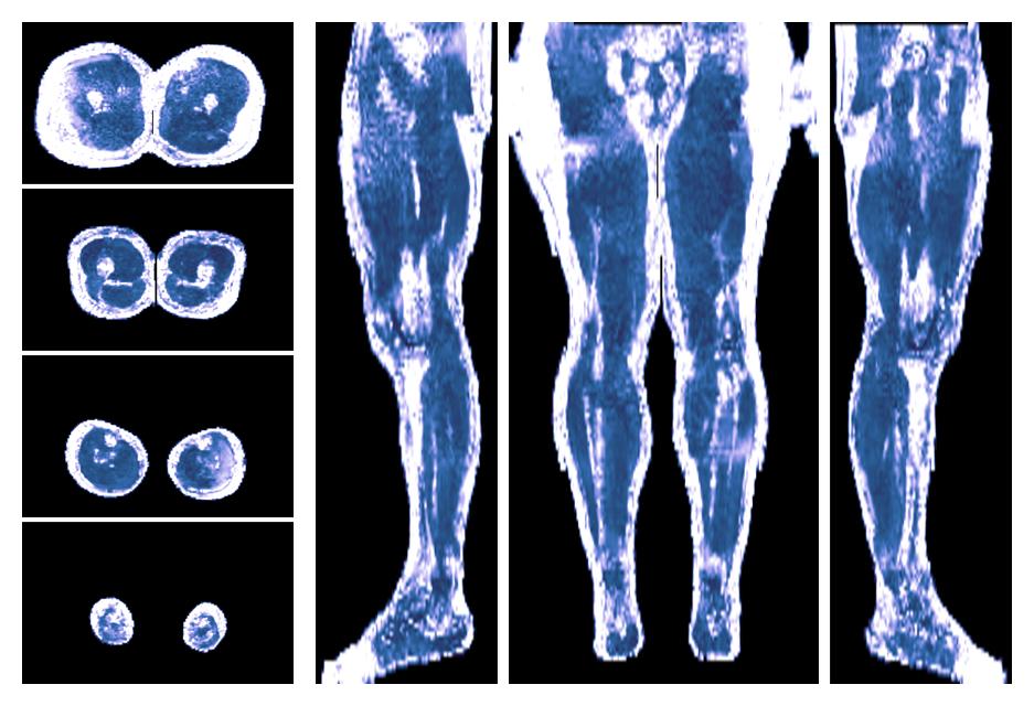 IVIM corrected whole leg muscle fractional anisotropy obtained from diffusion tensor imaging.