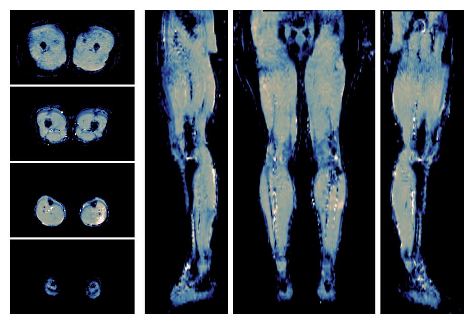 IVIM corrected whole leg muscle mean diffusivity obtained from diffusion tensor imaging.