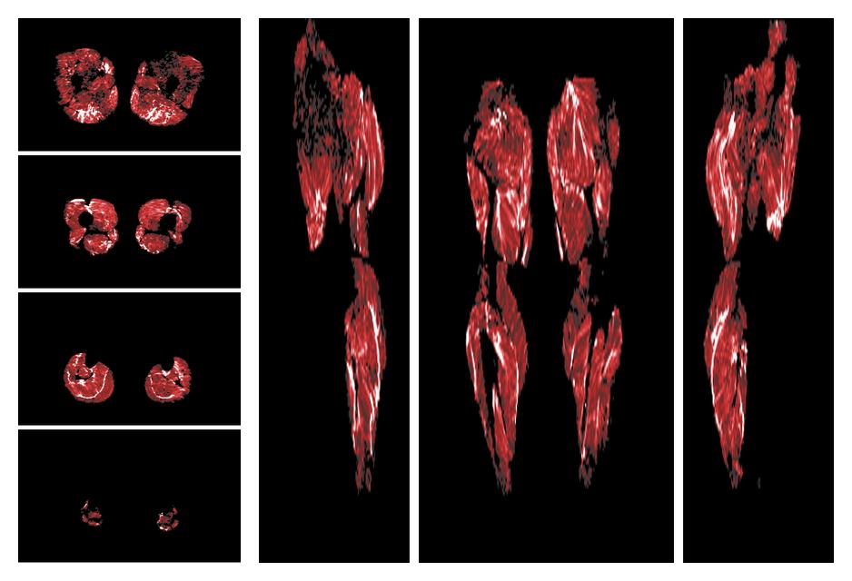 Muscle fiber tract density map based on whole leg DTI based fiber tractography.