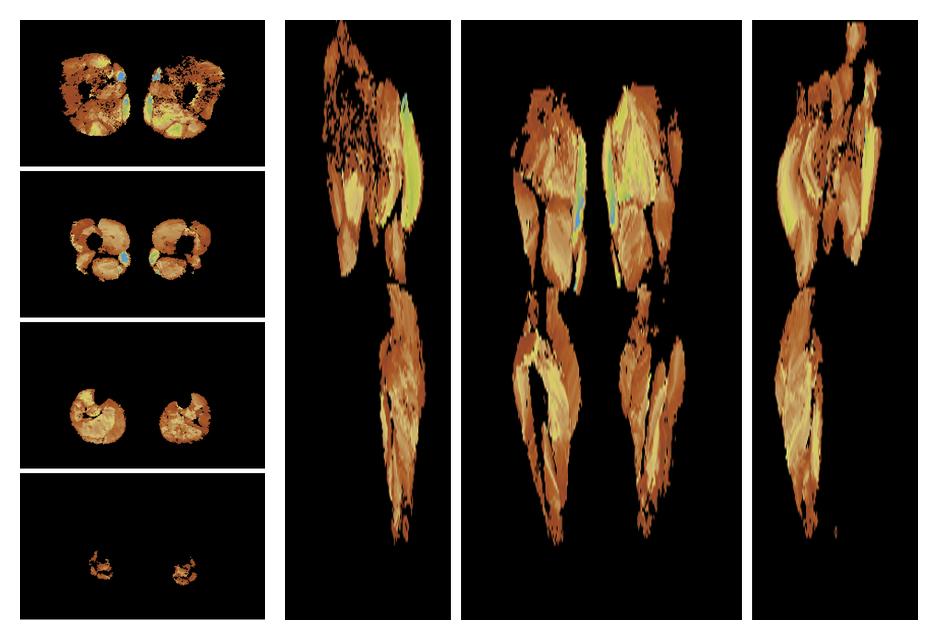 Muscle fiber tract length map based on whole leg DTI based fiber tractography.