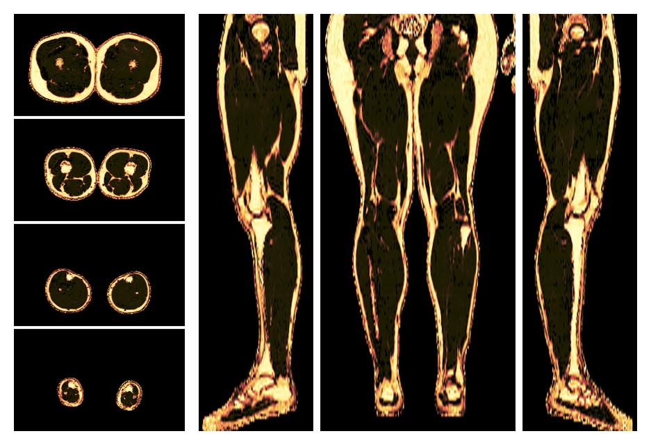 The fat fraction of the lower extremity obtained from the dixon reconstruction for muscle water fat quantification.