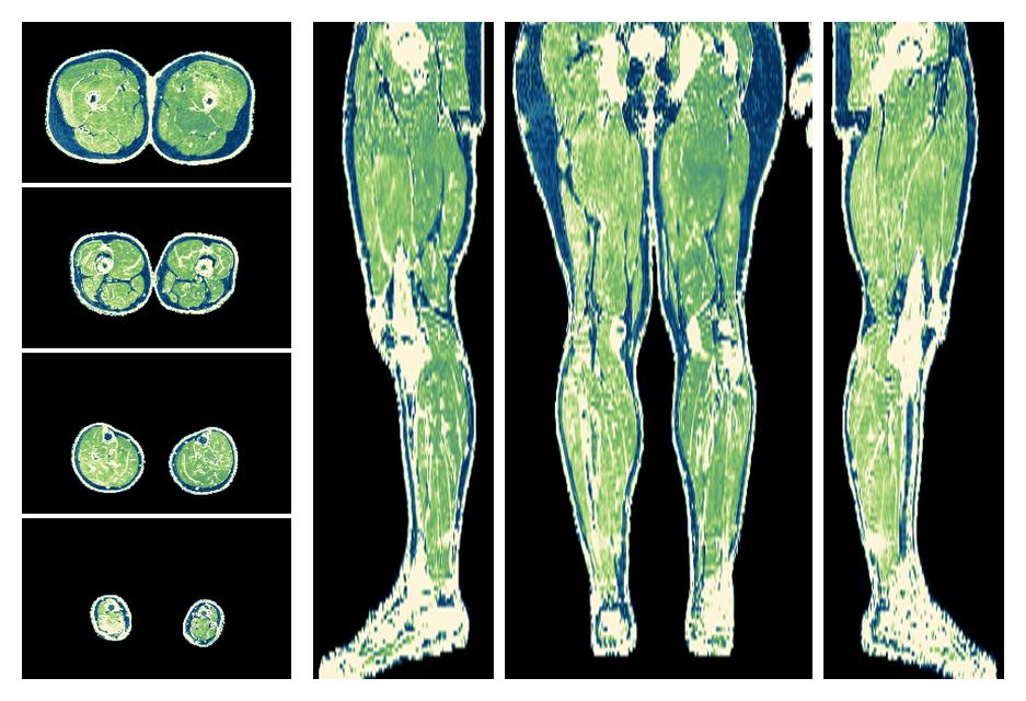 The R2 star relaxation time of the lower extremity obtained from the dixon reconstruction for muscle water fat quantification.