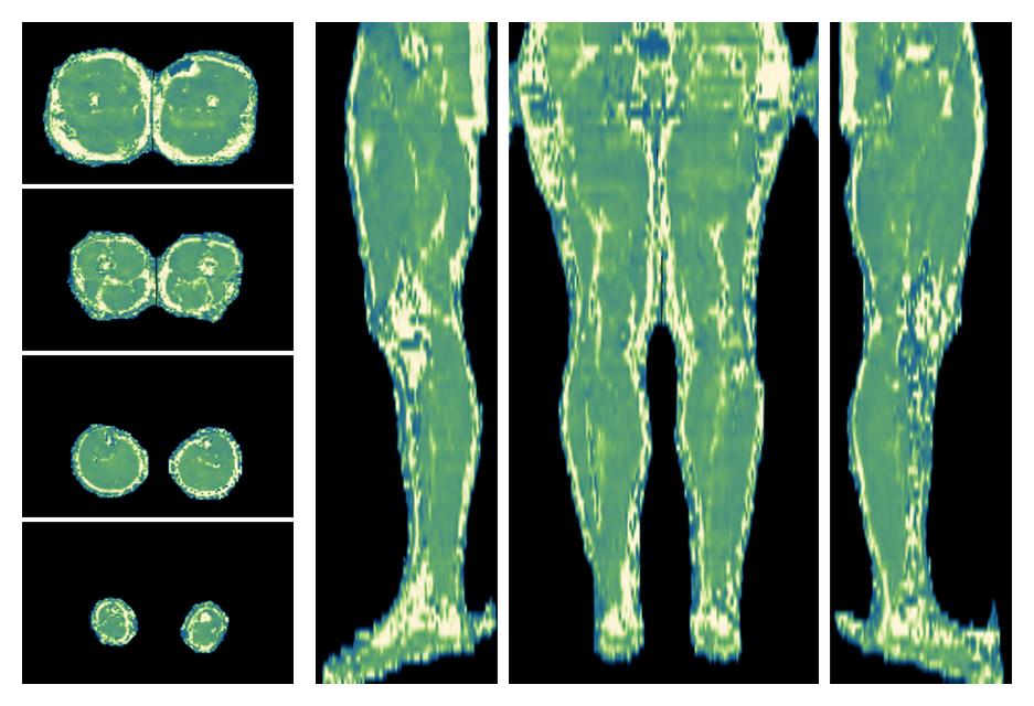 The water only T2 relaxation time of the lower extremity obtained from multi echo spin echo t2 mapping with EPG based reconstruction.