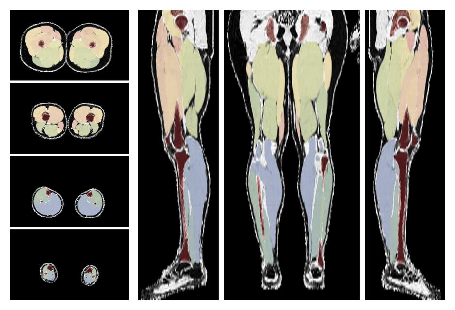 Overlay of automated muscle segmentation labels on dixon water image.