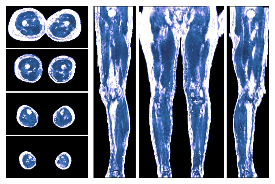 IVIM corrected whole leg muscle fractional anisotropy obtained from diffusion tensor imaging.