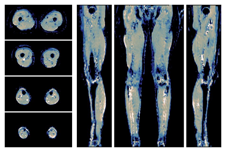 IVIM corrected whole leg muscle mean diffusivity obtained from diffusion tensor imaging.