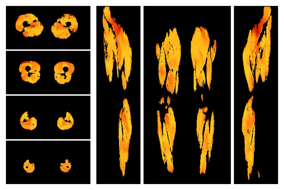 Muscle fiber tract angle map based on whole leg DTI based fiber tractography.