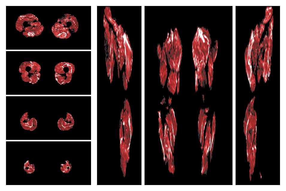 Muscle fiber tract density map based on whole leg DTI based fiber tractography.