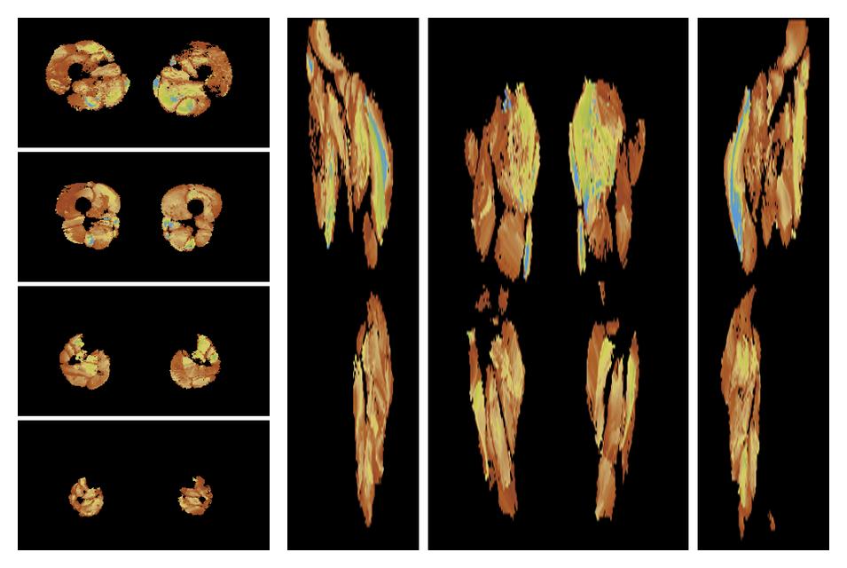 Muscle fiber tract length map based on whole leg DTI based fiber tractography.