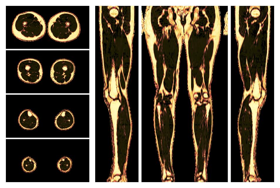 The fat fraction of the lower extremity obtained from the dixon reconstruction for muscle water fat quantification.