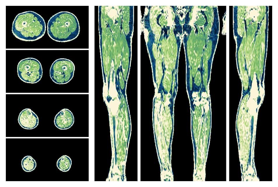 The R2 star relaxation time of the lower extremity obtained from the dixon reconstruction for muscle water fat quantification.