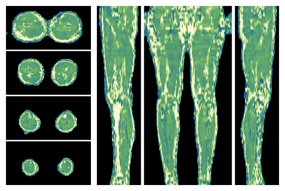 The water only T2 relaxation time of the lower extremity obtained from multi echo spin echo t2 mapping with EPG based reconstruction.