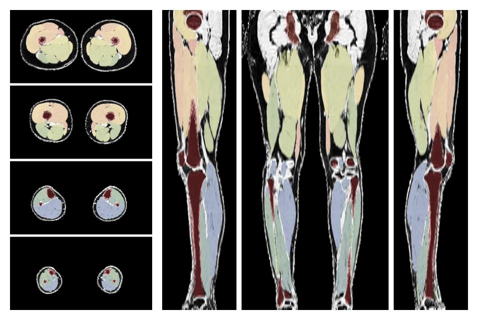 Overlay of automated muscle segmentation labels on dixon water image.