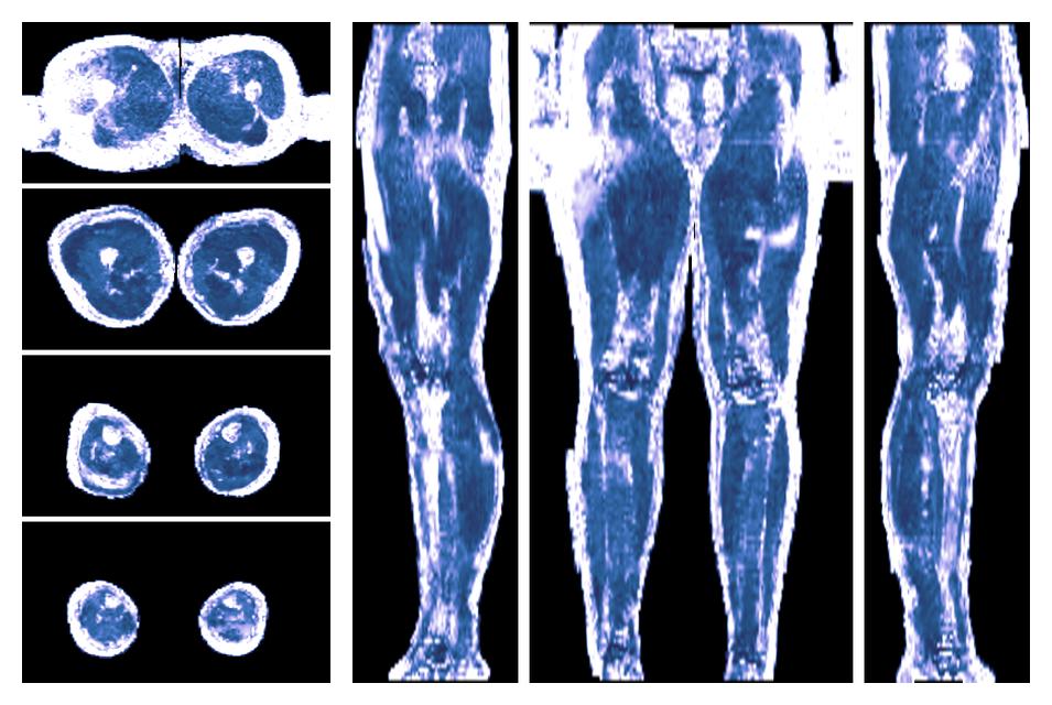 IVIM corrected whole leg muscle fractional anisotropy obtained from diffusion tensor imaging.