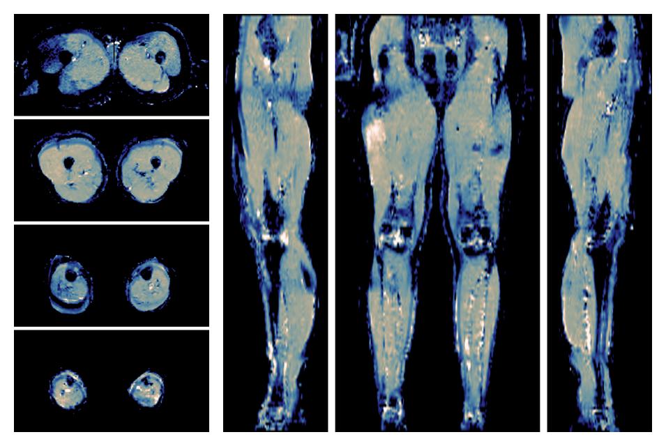 IVIM corrected whole leg muscle mean diffusivity obtained from diffusion tensor imaging.