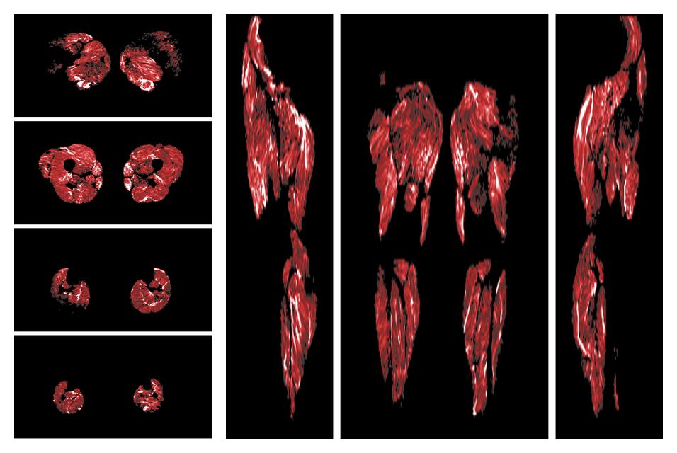 Muscle fiber tract density map based on whole leg DTI based fiber tractography.