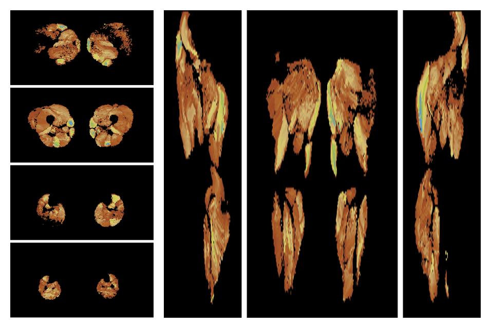 Muscle fiber tract length map based on whole leg DTI based fiber tractography.