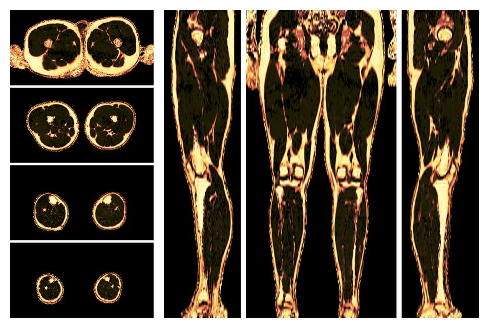 The fat fraction of the lower extremity obtained from the dixon reconstruction for muscle water fat quantification.