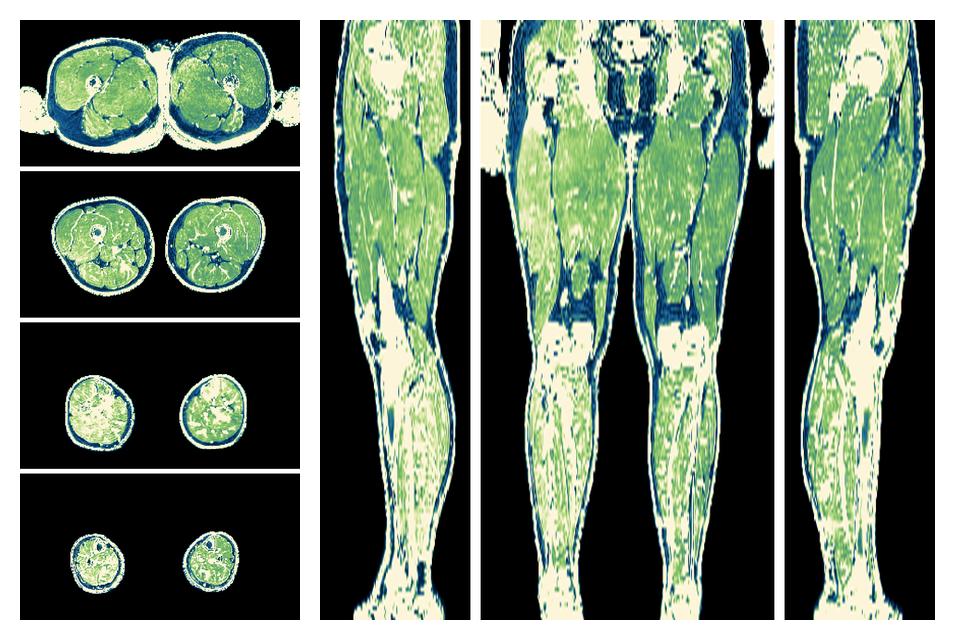 The R2 star relaxation time of the lower extremity obtained from the dixon reconstruction for muscle water fat quantification.