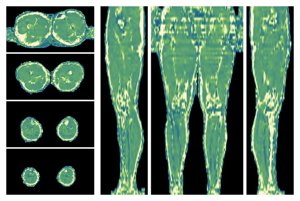 The water only T2 relaxation time of the lower extremity obtained from multi echo spin echo t2 mapping with EPG based reconstruction.