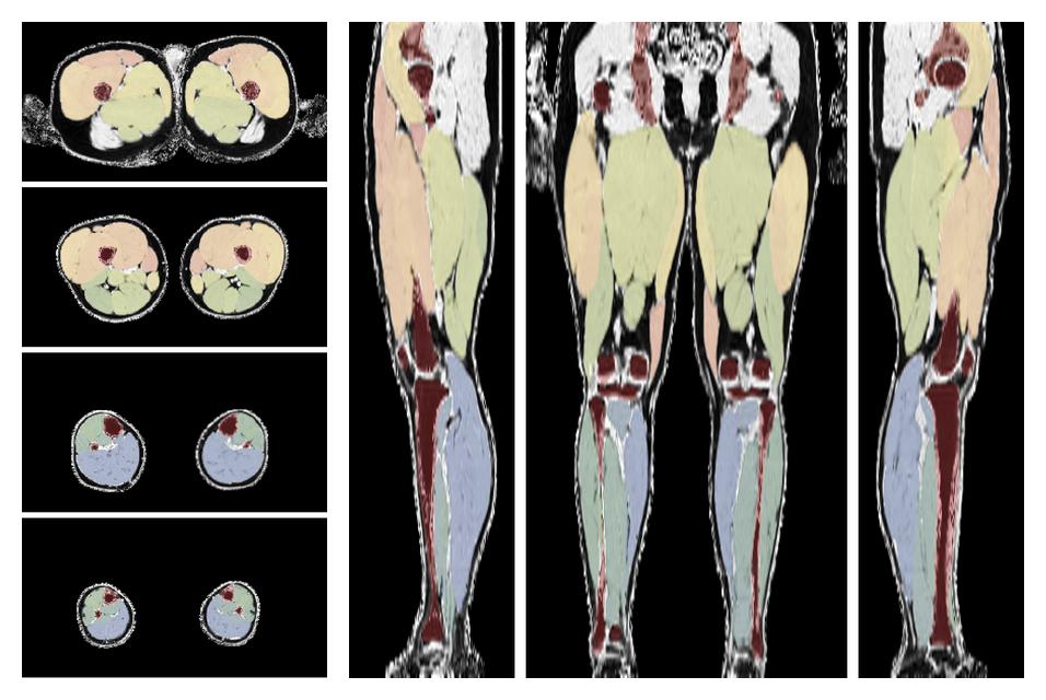 Overlay of automated muscle segmentation labels on dixon water image.