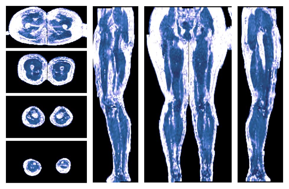 IVIM corrected whole leg muscle fractional anisotropy obtained from diffusion tensor imaging.