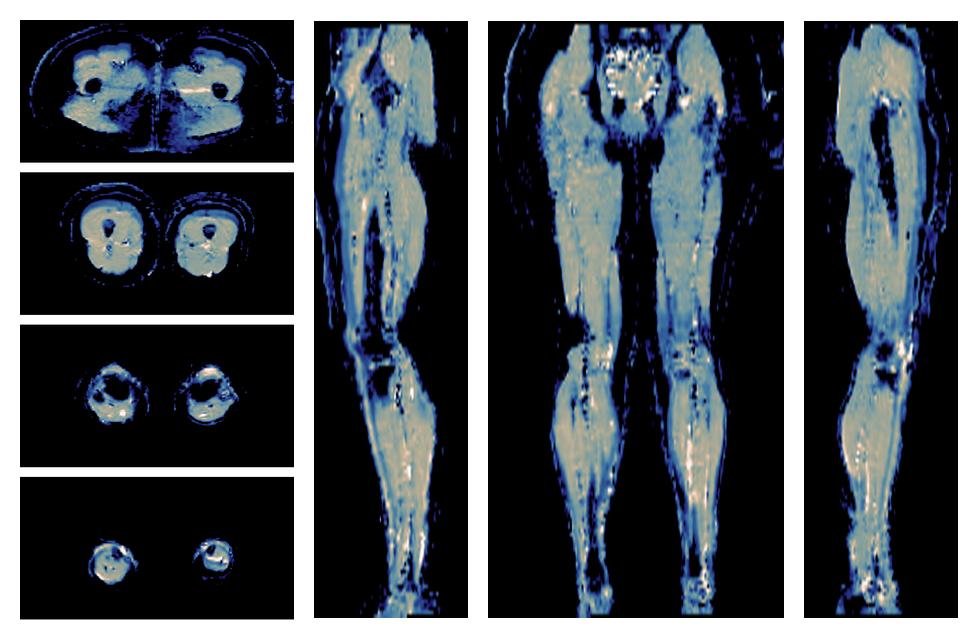 IVIM corrected whole leg muscle mean diffusivity obtained from diffusion tensor imaging.