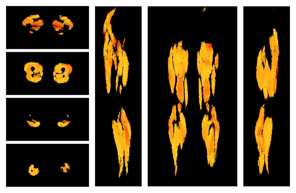 Muscle fiber tract angle map based on whole leg DTI based fiber tractography.