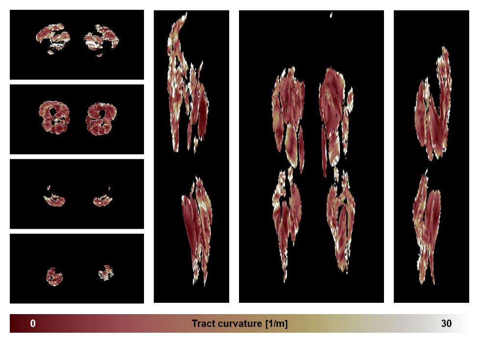 Muscle fiber tract curvature map based on whole leg DTI based fiber tractography.