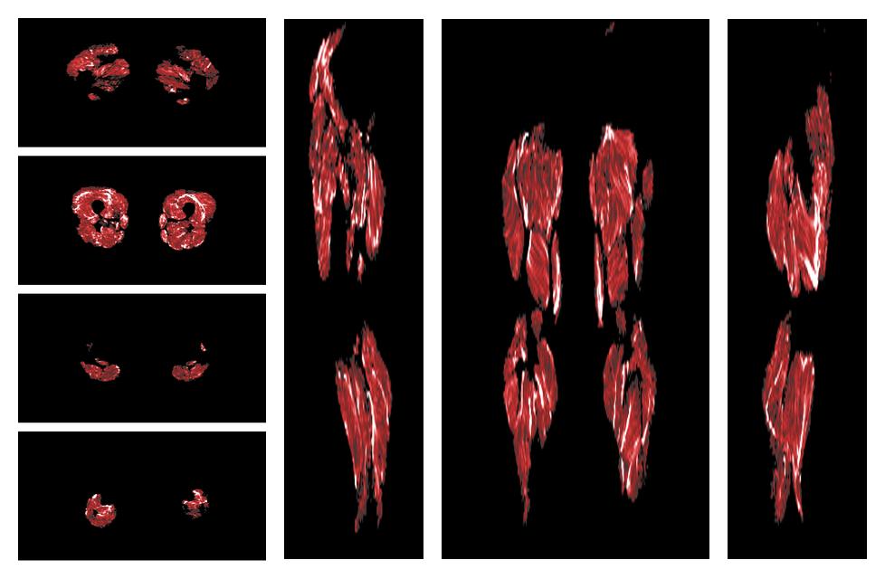 Muscle fiber tract density map based on whole leg DTI based fiber tractography.