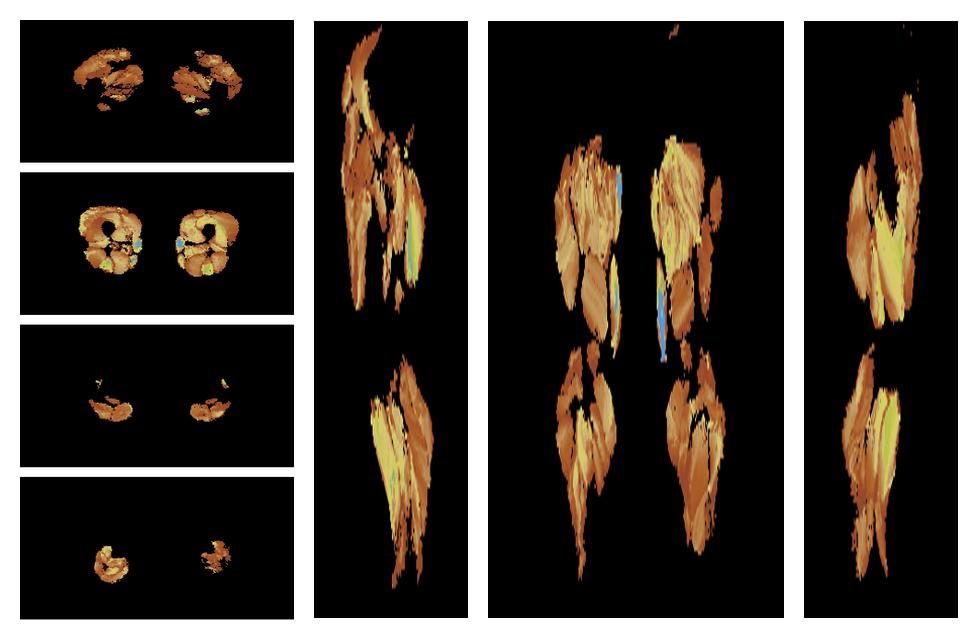 Muscle fiber tract length map based on whole leg DTI based fiber tractography.