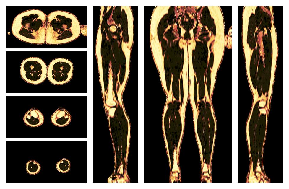 The fat fraction of the lower extremity obtained from the dixon reconstruction for muscle water fat quantification.