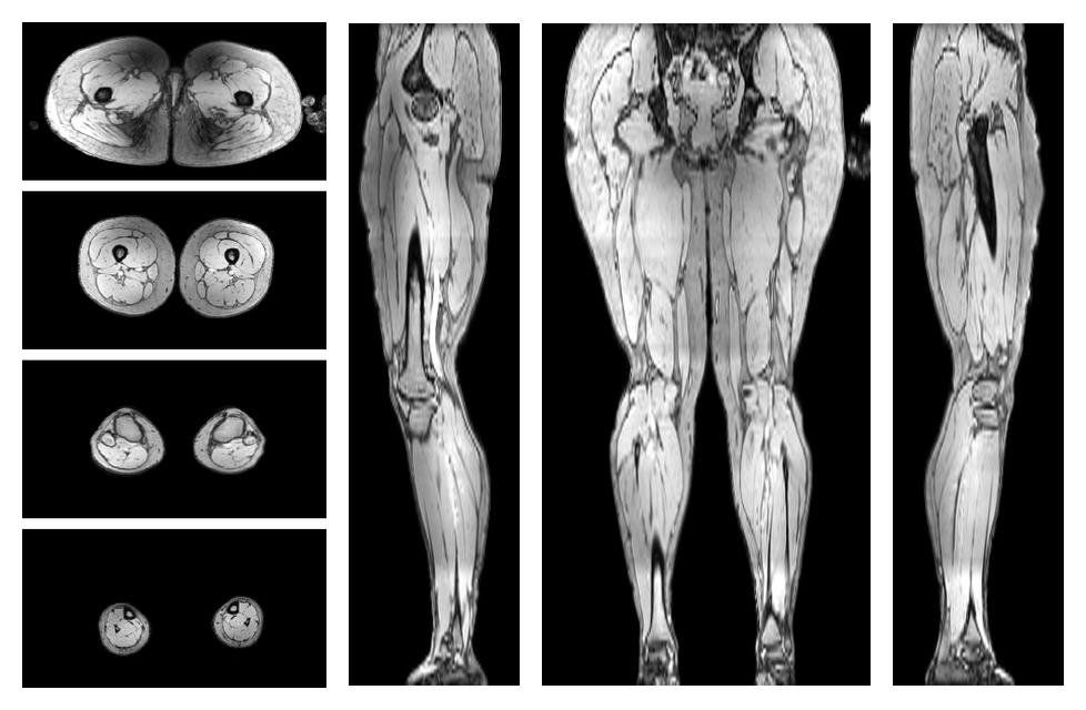 The out-phase image of the dixon reconstruction for water fat quantification.