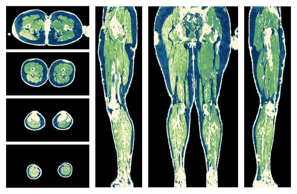 The R2 star relaxation time of the lower extremity obtained from the dixon reconstruction for muscle water fat quantification.