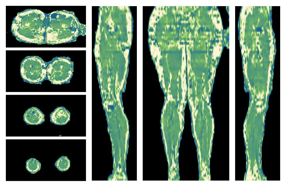 The water only T2 relaxation time of the lower extremity obtained from multi echo spin echo t2 mapping with EPG based reconstruction.