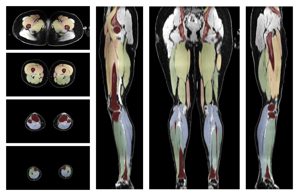 Overlay of automated muscle segmentation labels on dixon water image.