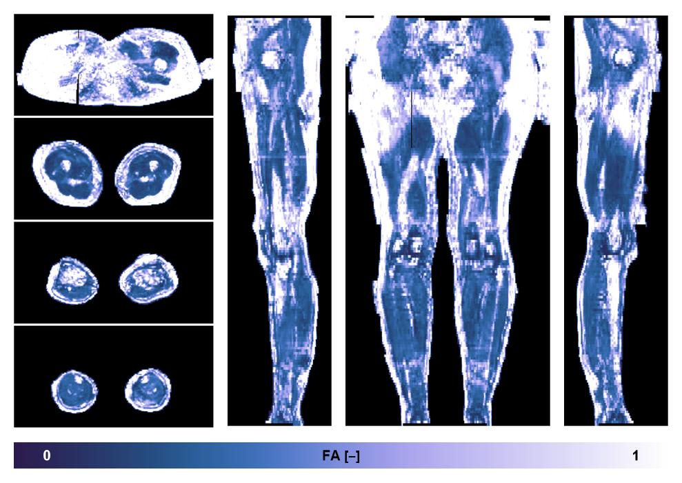 IVIM corrected whole leg muscle fractional anisotropy obtained from diffusion tensor imaging.