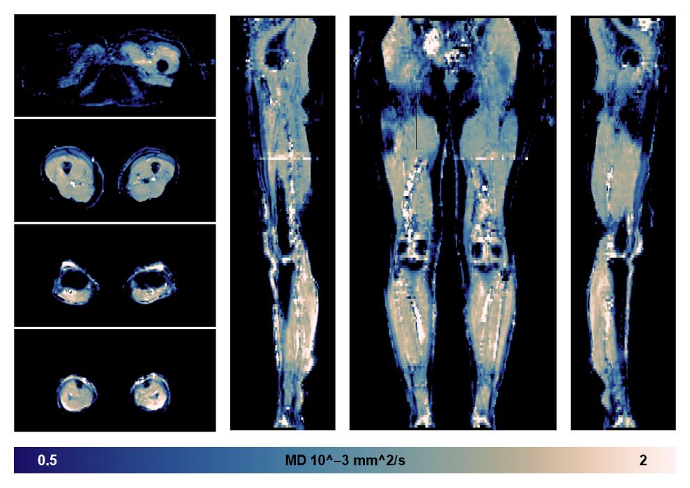 IVIM corrected whole leg muscle mean diffusivity obtained from diffusion tensor imaging.