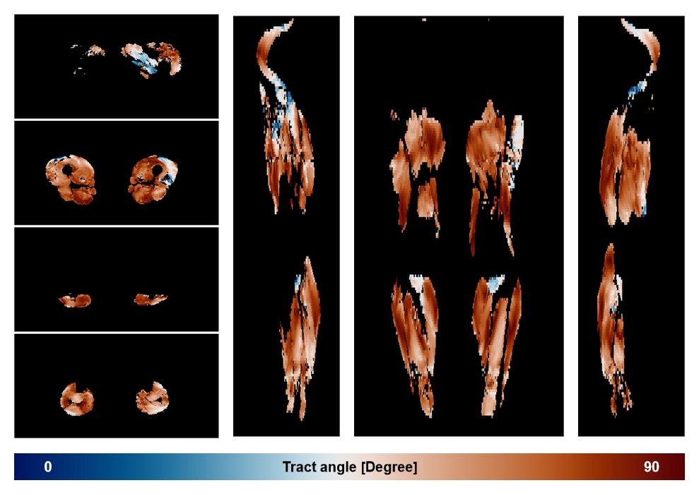 Muscle fiber tract angle map based on whole leg DTI based fiber tractography.