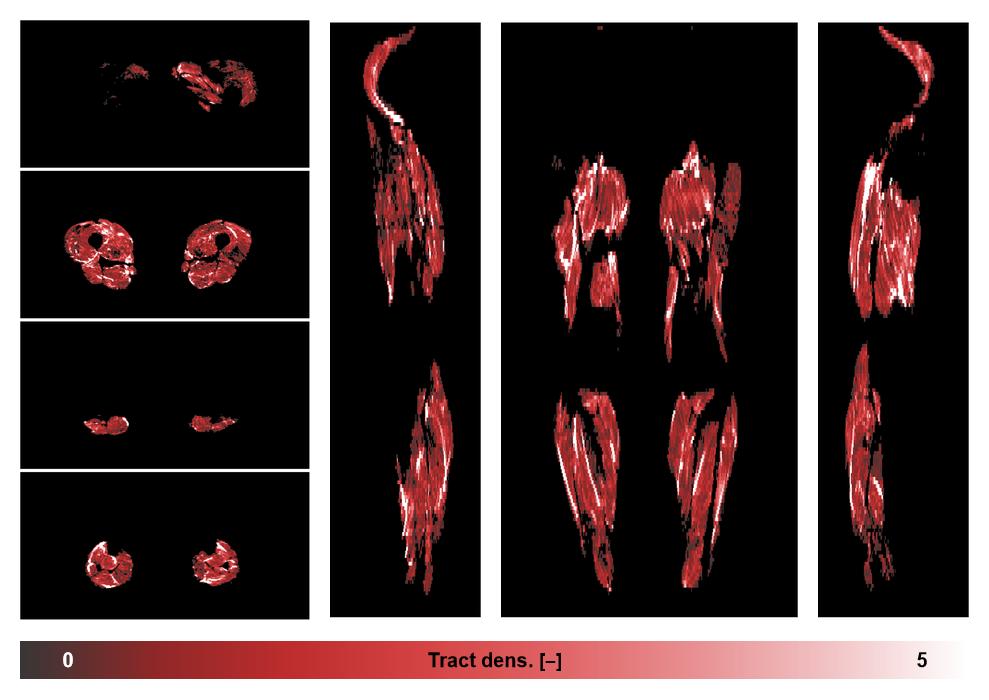 Muscle fiber tract density map based on whole leg DTI based fiber tractography.