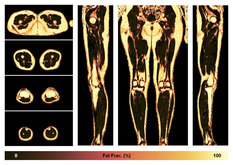 The fat fraction of the lower extremity obtained from the dixon reconstruction for muscle water fat quantification.