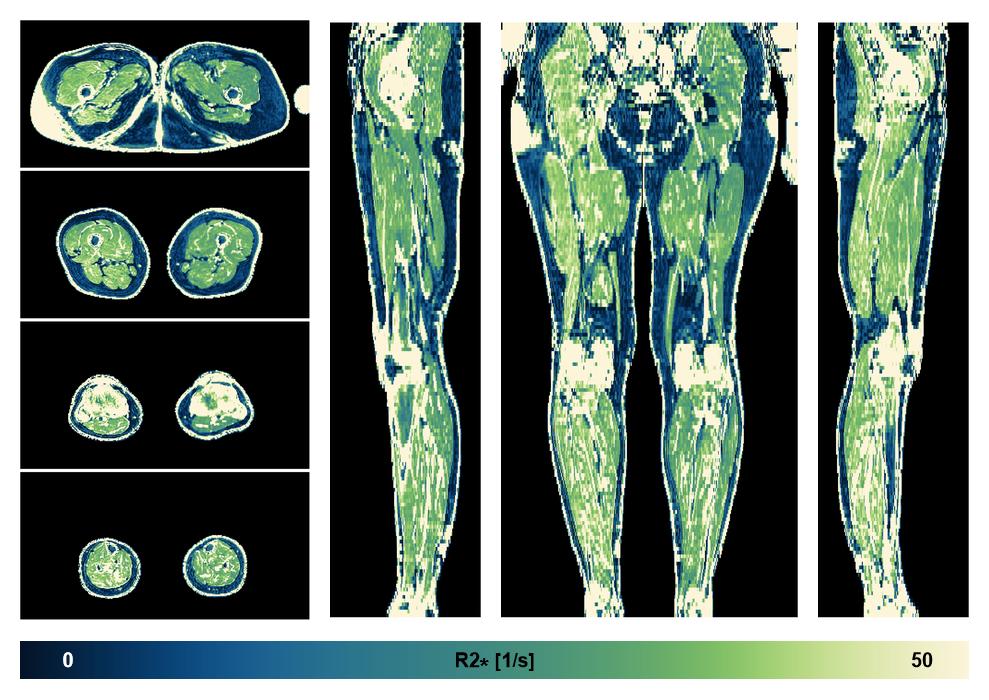 The R2 star relaxation time of the lower extremity obtained from the dixon reconstruction for muscle water fat quantification.