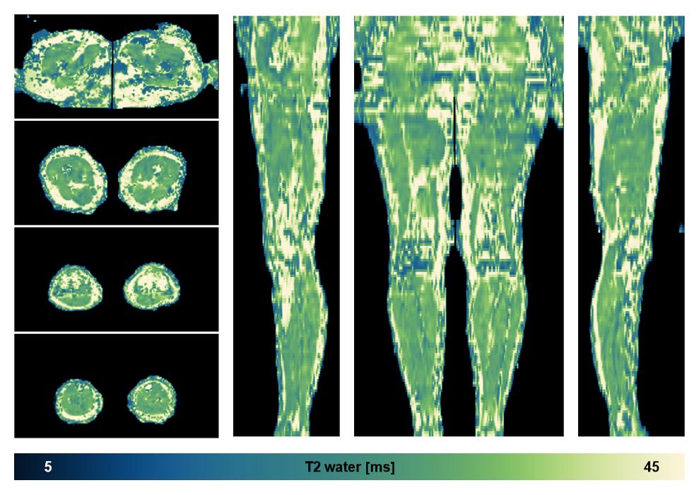 The water only T2 relaxation time of the lower extremity obtained from multi echo spin echo t2 mapping with EPG based reconstruction.