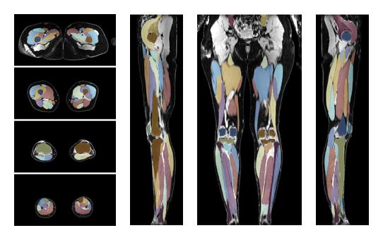 Overlay of automated muscle segmentation labels on dixon water image.