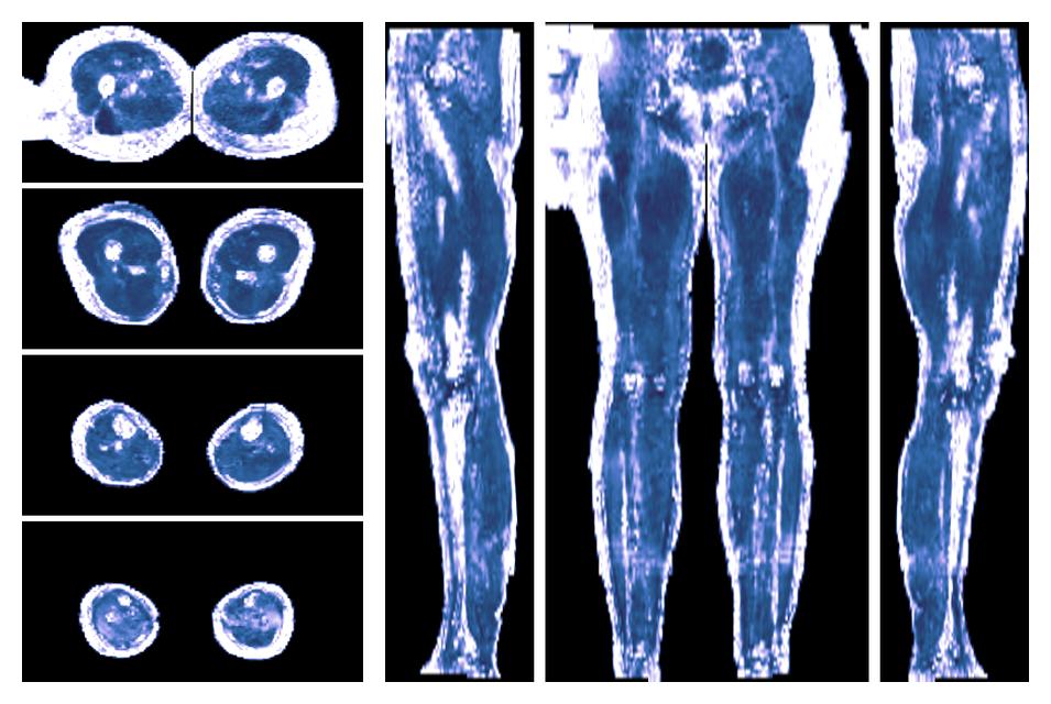 IVIM corrected whole leg muscle fractional anisotropy obtained from diffusion tensor imaging.